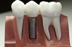 dental implants