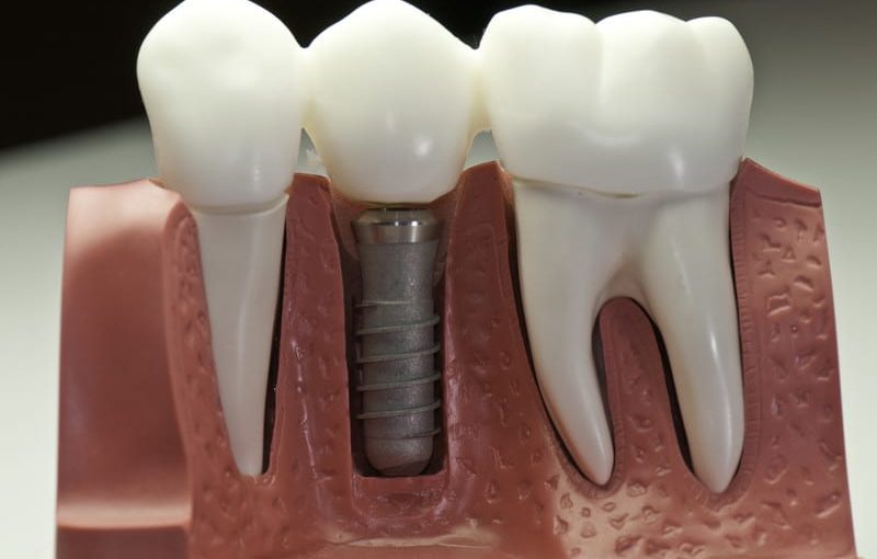 dental implants