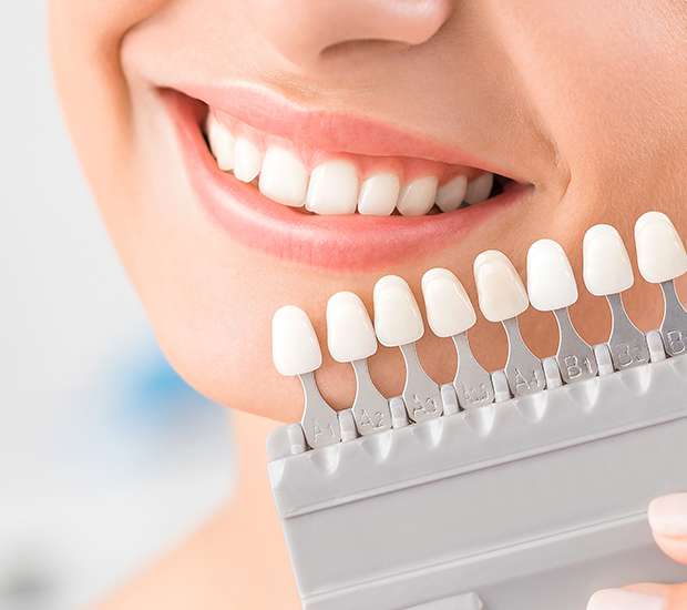 The Benefits of Dental Veneers