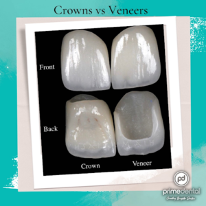 Dental Crowns and Veneers