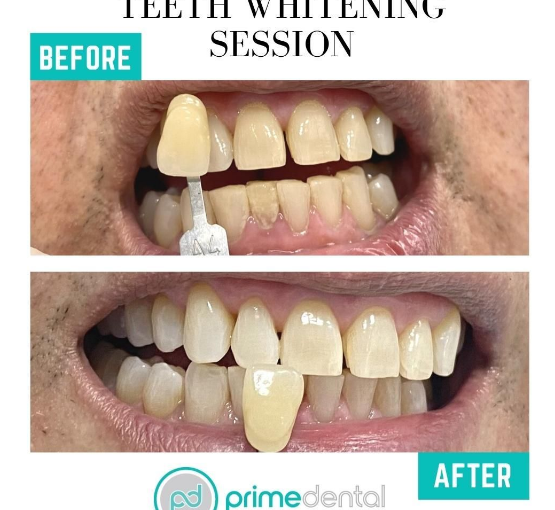 Teeth Whitening Sessions