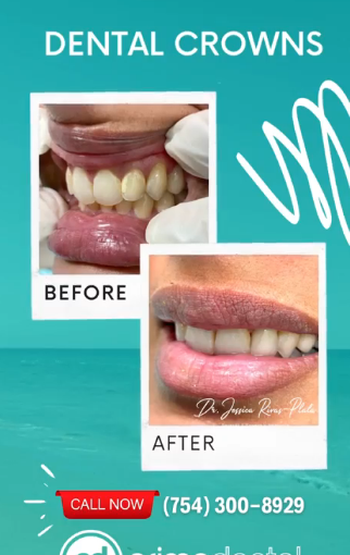 Smile Transformation With Dental Crowns