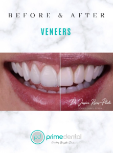 Dental Veneers