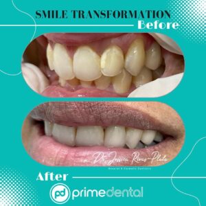 Smile Transformation