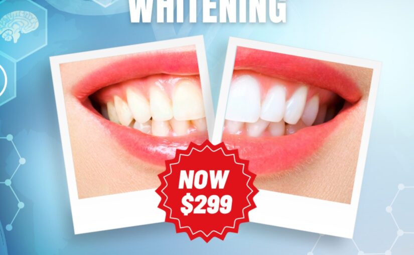 Teeth Whitening Session