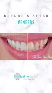 Dental Veneers