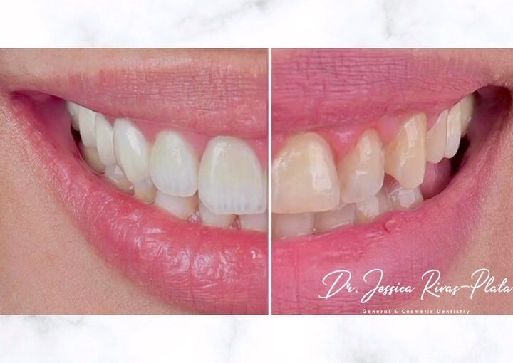 Dental Veneers