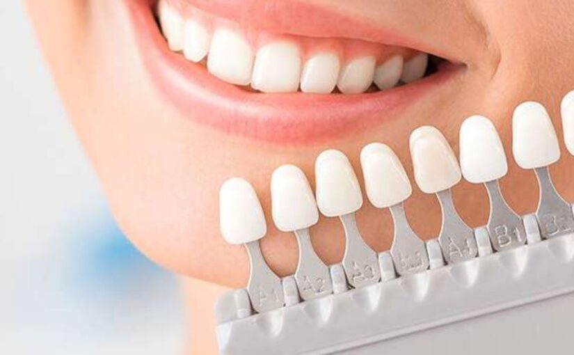 Dental Veneers