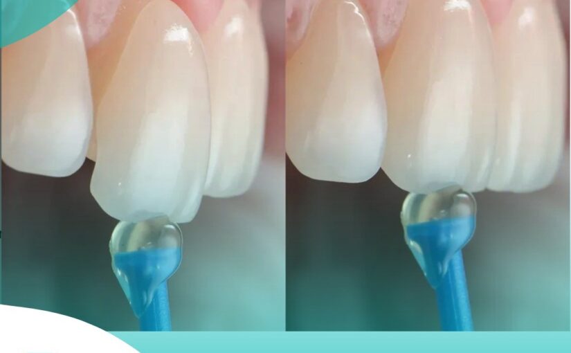 Long-Lasting Smile Transformation with Dental Veneers