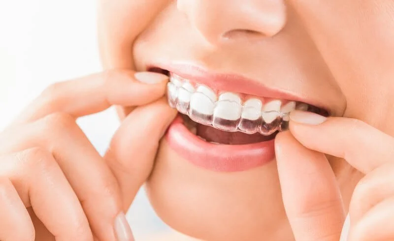 Dentist in Davie, FL: Comprehensive Dental Care You Can Trust 6 invisalign