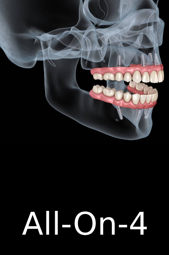 Dental Implants in Pembroke Pines