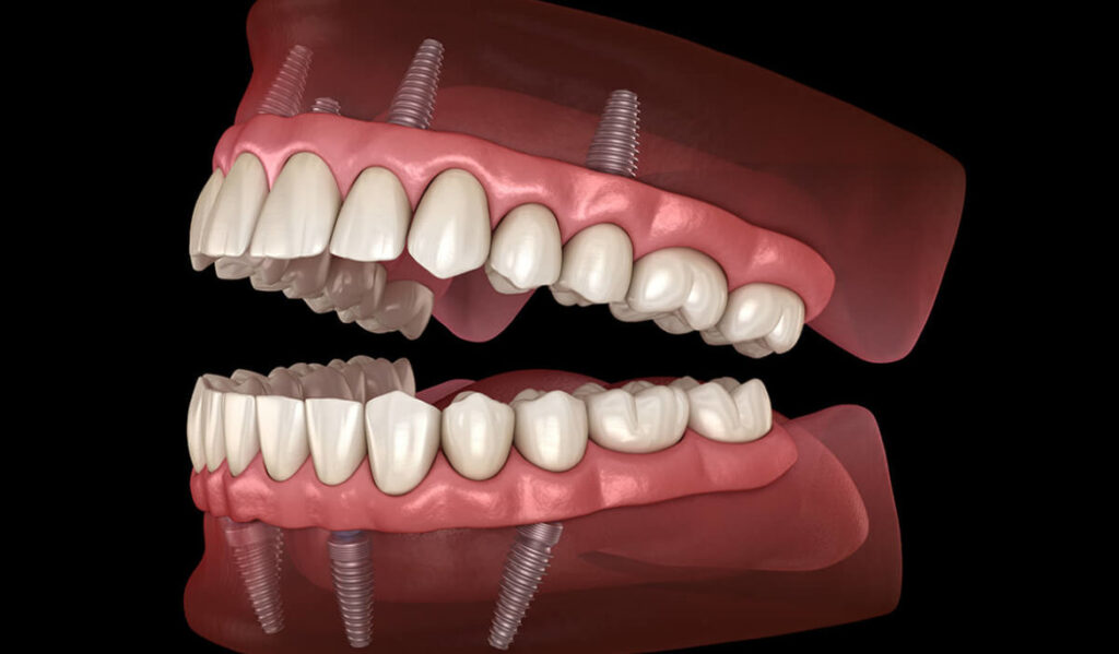 Dentist in Plantation, FL: Comprehensive Dental Care You Can Trust 4 Benefits of All-on-X