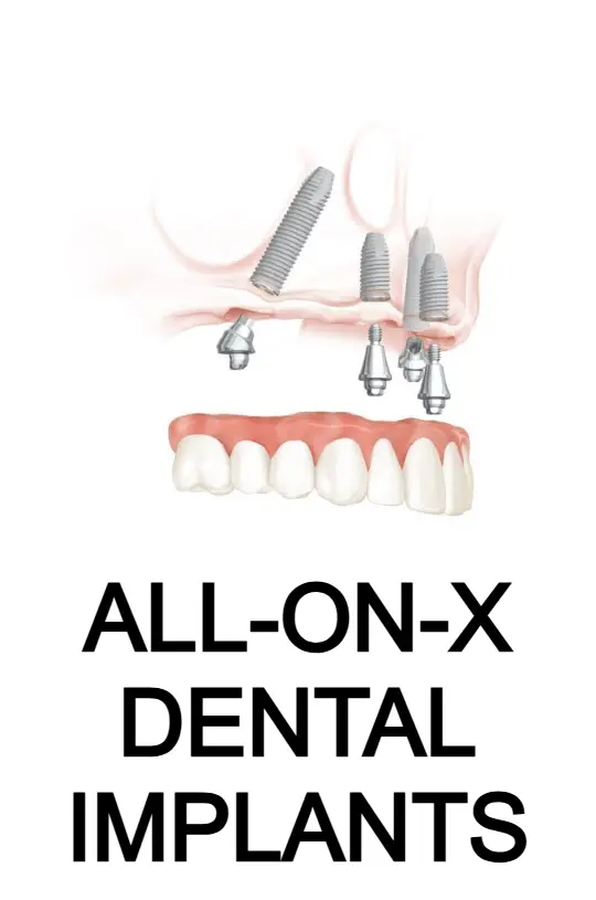 All-on-X Dental Implants in Pembroke Pines