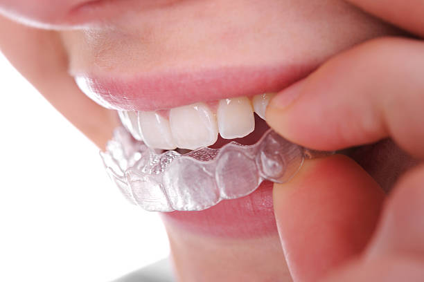 Dentist in Southwest Ranches, FL: Comprehensive Dental Care You Can Trust 6 Clear Aligners invisalign