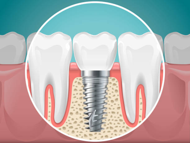 Dentist in Southwest Ranches, FL: Comprehensive Dental Care You Can Trust 4 Dental Implants