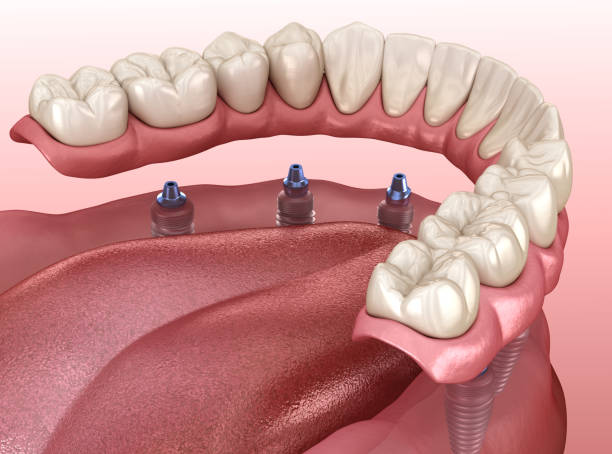 all on x implants
