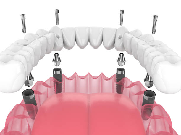 all-on-4 dental implants