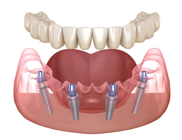 z all on 4 implants