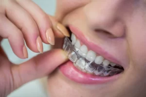 Clear Aligners vs. Traditional Braces