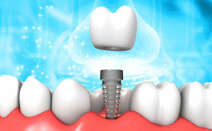 dental implants for missing teeth
