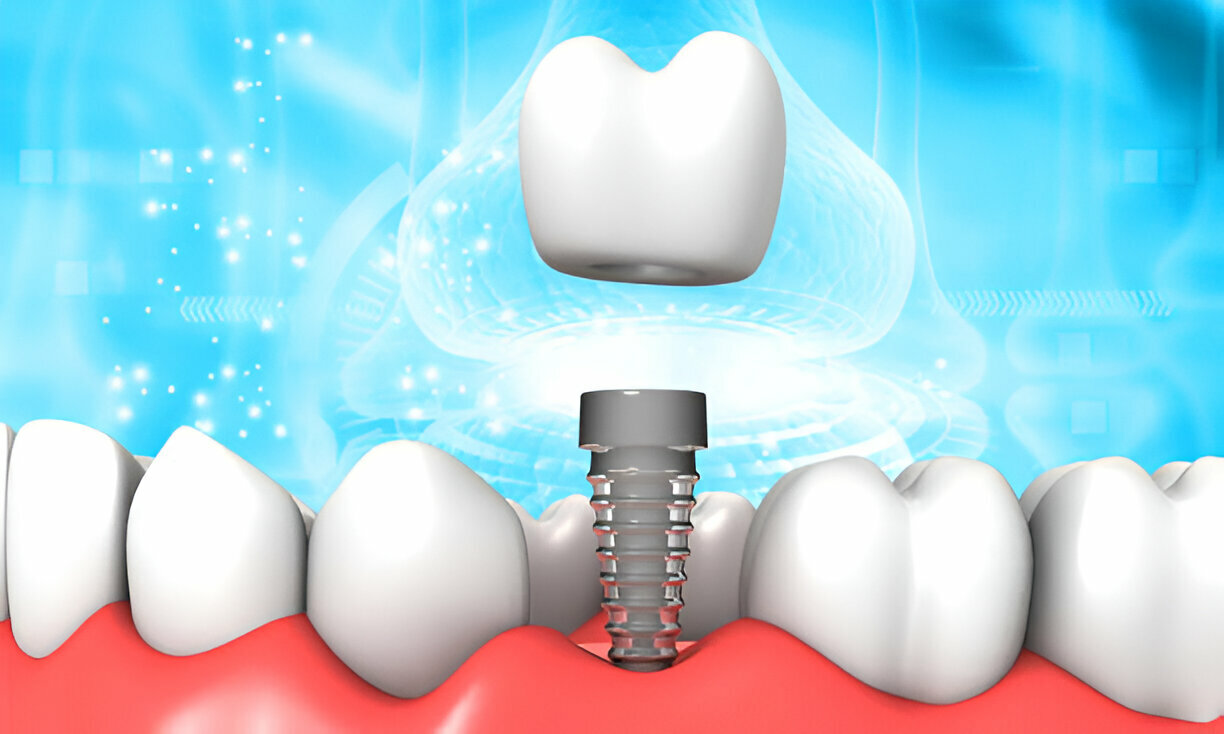dental implants for missing teeth