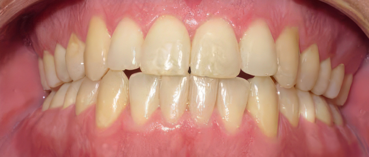 prime dental clear aligners after