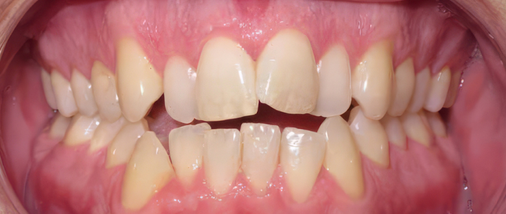prime dental clear aligners before