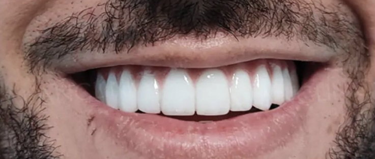 Prime dental implants after