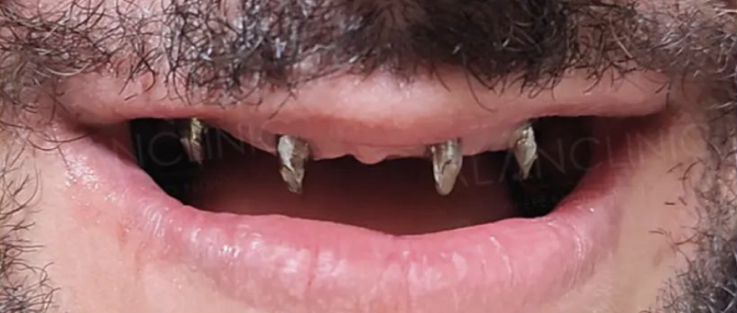 Prime dental implants