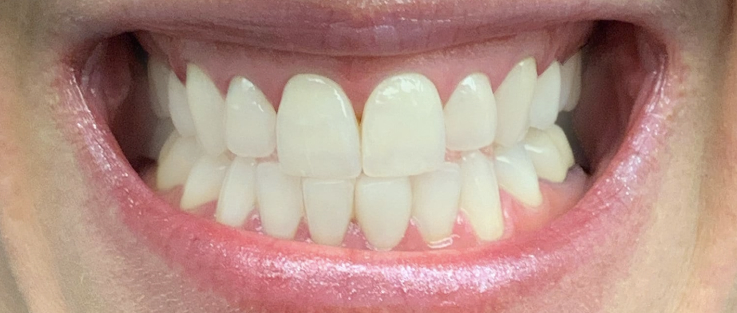 Prime dental teeth whitening after