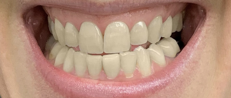 Prime dental teeth whitening before