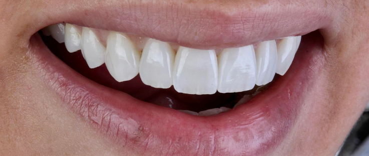 prime dental venners after