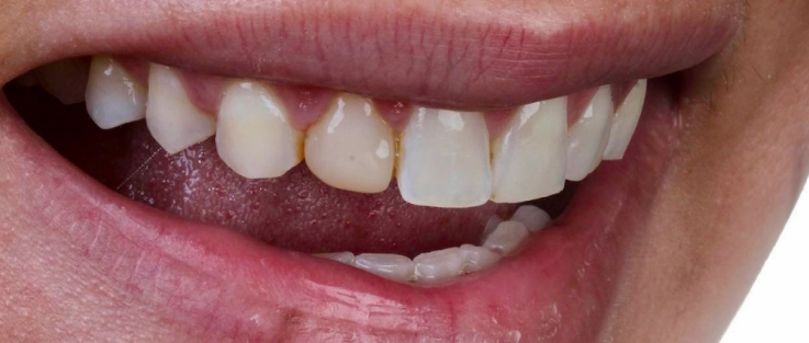 prime dental venners before