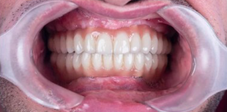 prime dental all implants dental