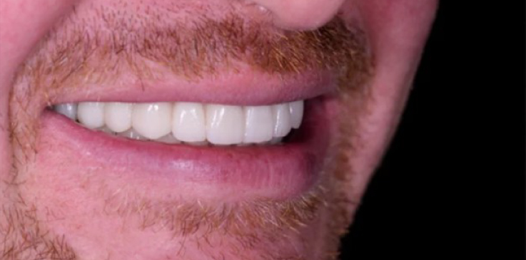 prime dental implants dental aestetics