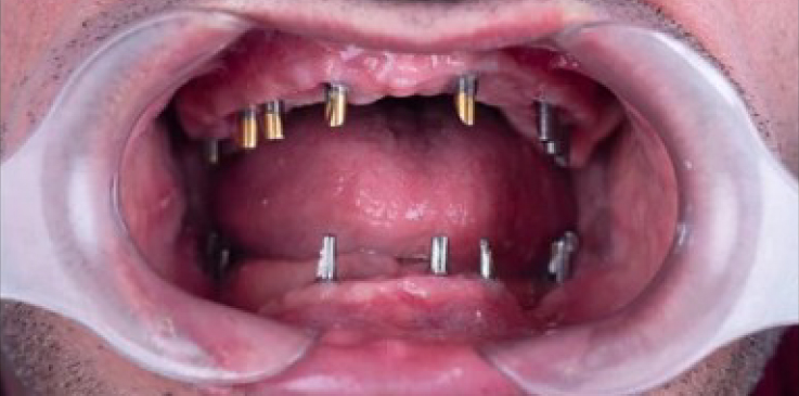 prime dental all implants dental