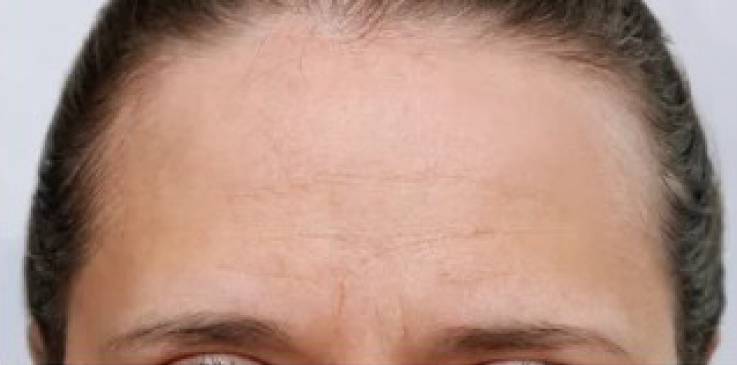 prime dental facial aestetics forehead