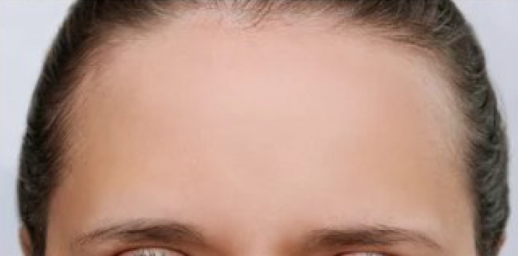 prime dental facial aestetics forehead